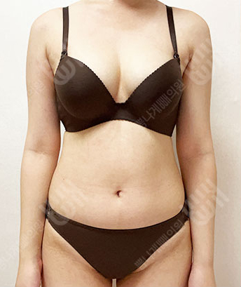 Before: 시술 전