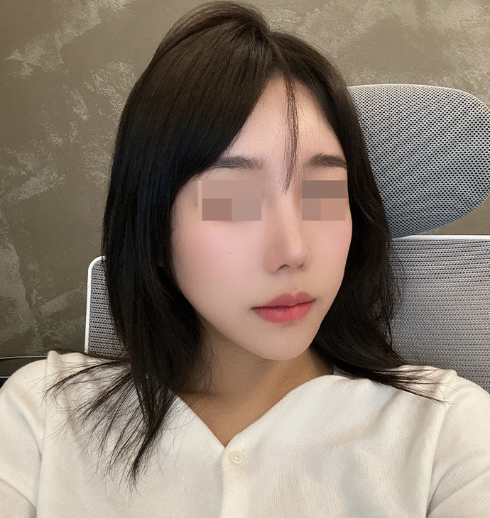 뽐나게빼의원 얼굴지방이식