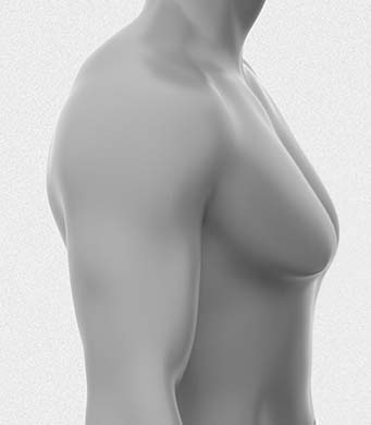 팔뚝지방흡입 부유방 이미지