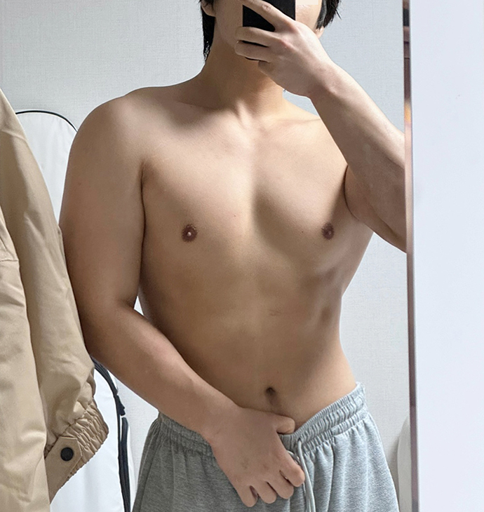 뽐나게빼의원 복부지방흡입